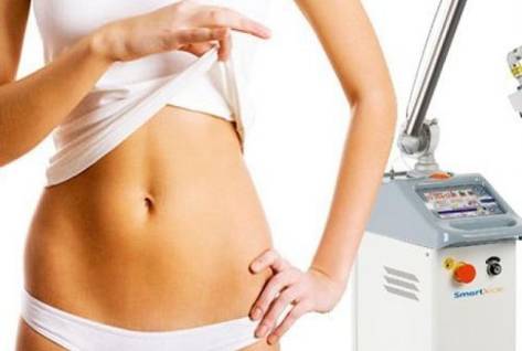 Удаление растяжек лазером нюансы процедуры - блог центра лазерной эпиляции в Киеве, Laser Health