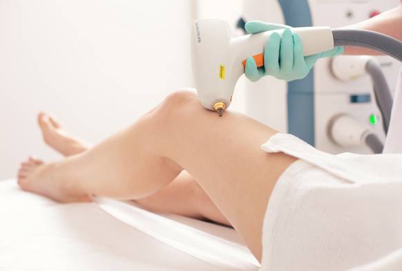 Лазерне видалення судин LUMENIS M22 в центре Laser Health