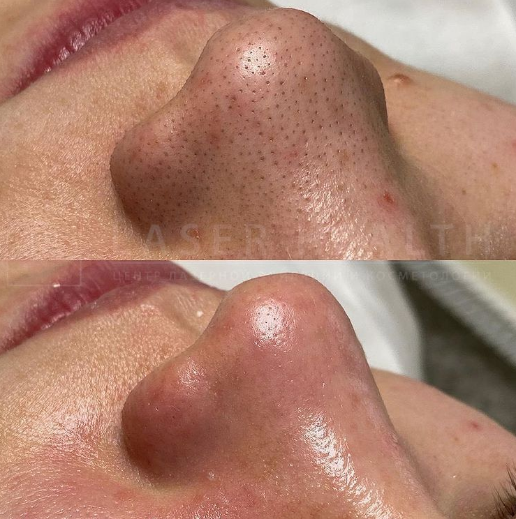 До и после ультразвуковой чистки лица, Laser Health